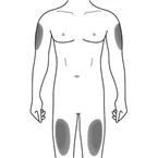 G:\BusUnits\Market Access\DRA\Product Folders\Cosentyx (AIN457)\Psoriasis (PsO)\Answer to Text Evaluation\per E-mail 16-Feb-15 (pictures + final proposal IFU)\AIN-Thigh+Arm.jpg