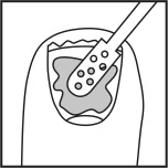 R:\Regulatory Affairs\Präparate\Fung-X Nail\Texte\Patienteninformation\Fung-X_Nail_Illustrationen_04.jpg